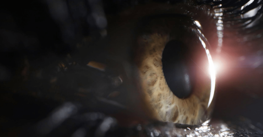 eye. Keratoconus surgery